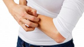 Eczema