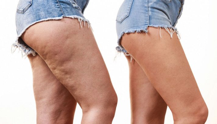 Cellulite, 5 cibi da evitare