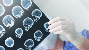 Alzheimer, all'università di Bari la malattia si predice col computer