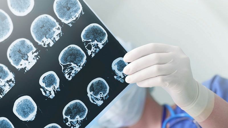 Alzheimer, all'università di Bari la malattia si predice col computer