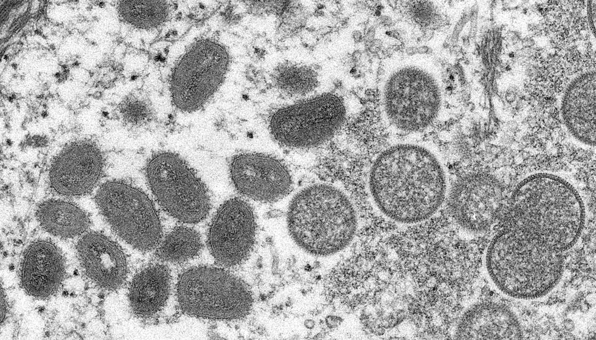 Vaiolo delle scimmie, ancora casi in Italia: quali sono i sintomi e quanto è probabile contrarre la malattia