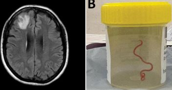 verme-parassita-cervello