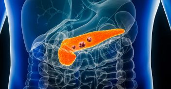 Nuova scoperta sul tumore al pancreas