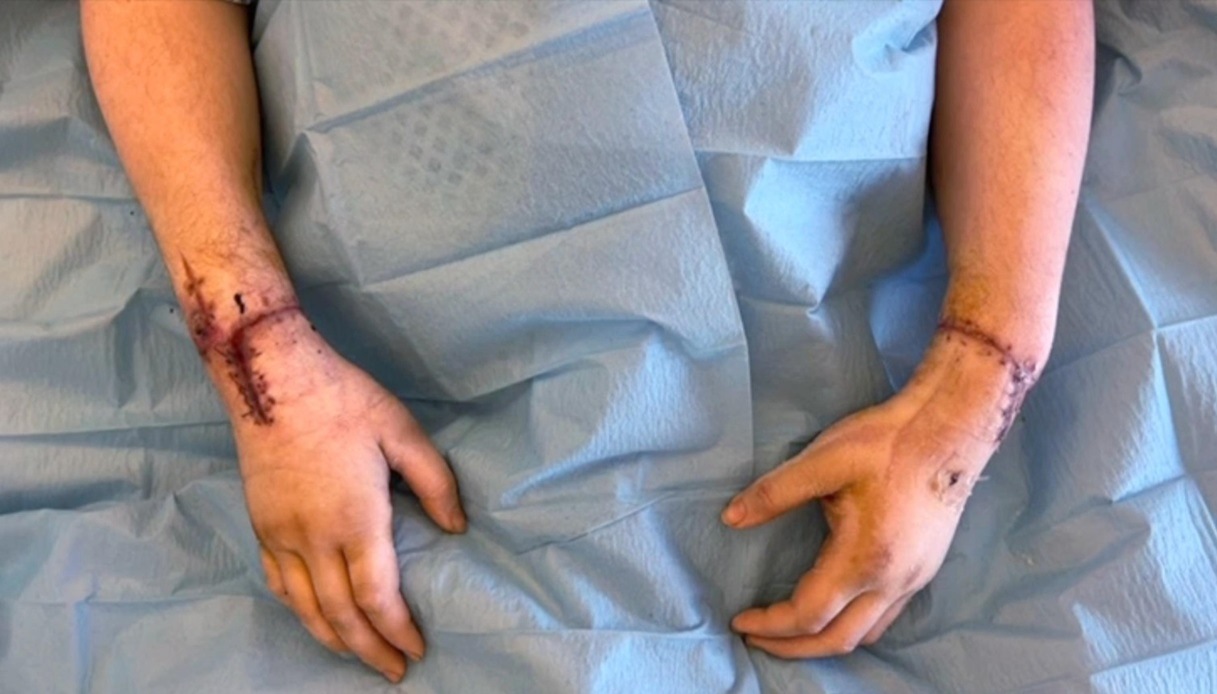 A un operaio di Verona sono stata reimpiantate le mani: l'uomo aveva perso gli arti in un incidente sul lavoro