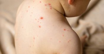 Morbillo nuove varianti