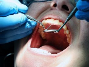 Dentista cura un 44enne convinto che abbia una gengivite mentre invece è un tumore: il paziente è morto