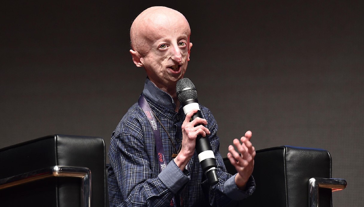 Morto Sammy Basso dopo un malore al ristorante: aveva 28 anni, era il malato di progeria più longevo al mondo