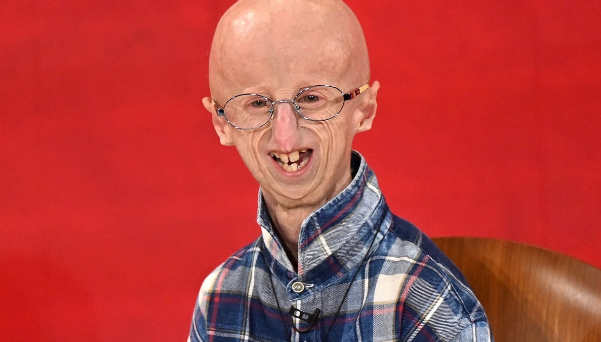 Sammy Basso e la progeria corpo non sarà donato alla scienza | il ...