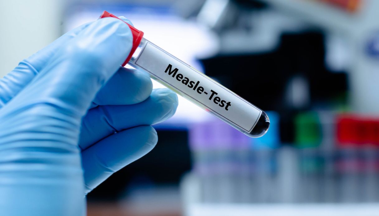 test morbillo