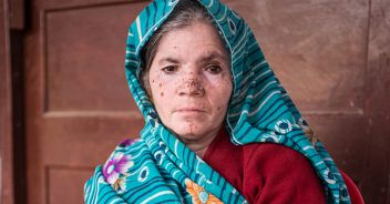 lebbra-romania-croazia-casi-italia