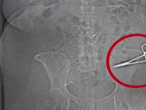 Operata a Napoli ma il chirurgo dimentica pinza di 15 centimetri in pancia: rimossa dopo 7 mesi d'antibiotico