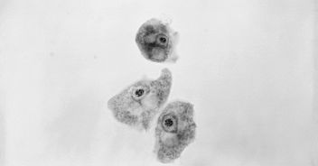 bambina-8-anni-ameba-mangia-cervello-naegleria-fowleri