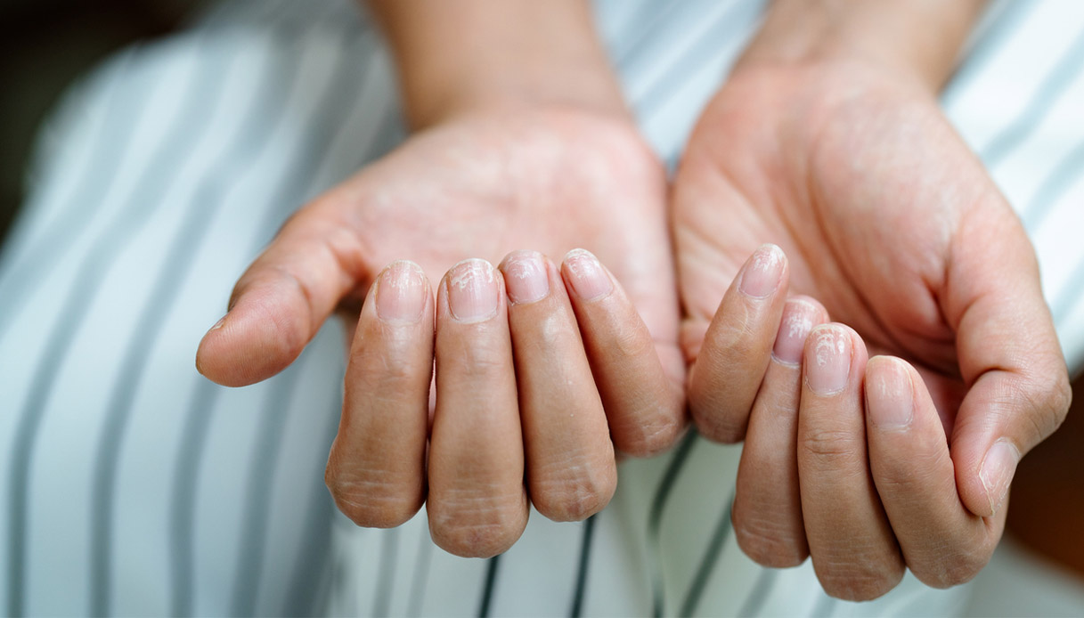 cos 232 il segno di hutchinson e come riconoscerlo quali sono i rischi del melanoma detto killer invisibile da Virgilio.it cos 232 il segno di hutchinson e come riconoscerlo quali sono i rischi del melanoma detto killer invisibile