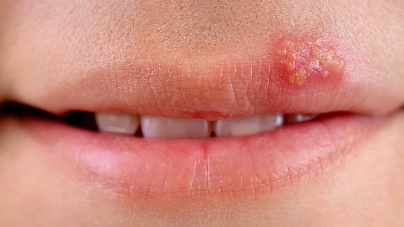 Febbre sulle labbra (herpes labiale): i rimedi più efficaci e