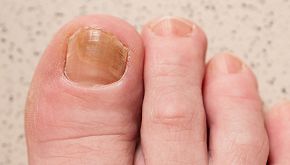 Unghie gialle dei piedi possono indicare 5 segni di malattia
