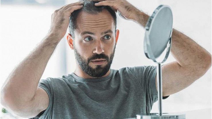 Trapianti di capelli: cos'è lo Smart FUE e quali vantaggi comporta
