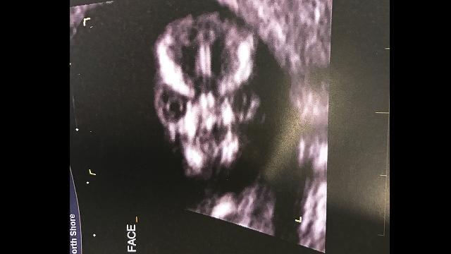 Ecografia da paura: il 'volto' del bambino terrorizza il web