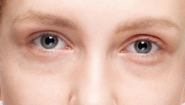 Sos occhiaie, ecco i rimedi per combattere occhi gonfi e borse