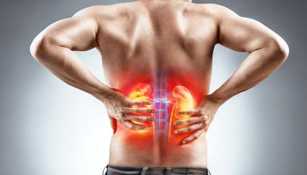 6 segnali che indicano che potresti soffrire di calcoli renali