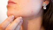 Maschera bicarbonato e aceto: ottima contro acne e macchie