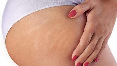 Come cancellare le smagliature: anche col "fai da te"