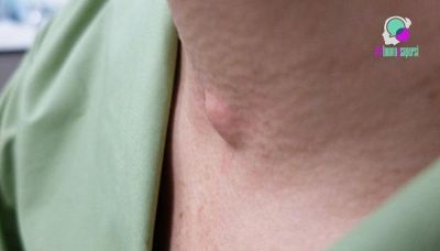 Come capire se hai un lipoma e come curarlo