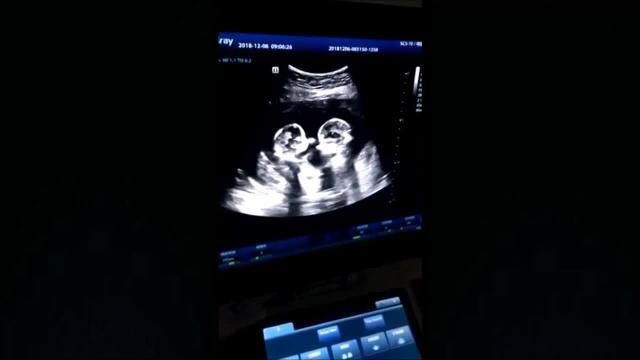 Le gemelline giocano nel grembo della mamma