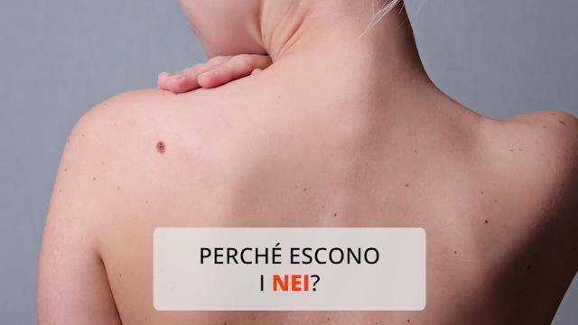 Cosa sono e perché escono i nei?
