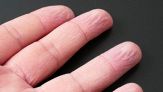 Perché le mani si “cuociono” quando stiamo tanto in mare?