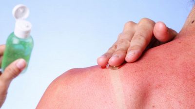 Scottature e arrossamenti? Ecco 7 doposole naturali