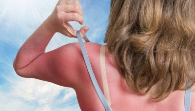 I rimedi green per le scottature solari