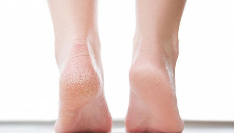 Il collutorio per i piedi? Il trucco per i talloni screpolati