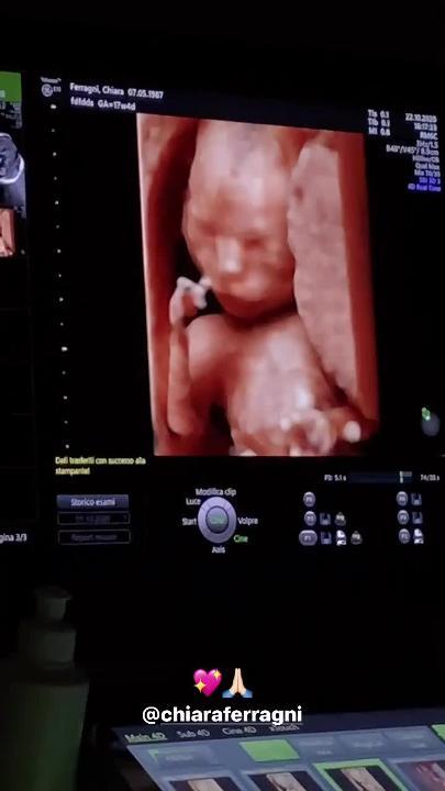 Chiara Ferragni vede il volto della figlia durante l'ecografia e si commuove