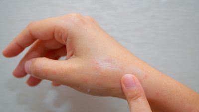 Come preparare un olio fai-da-te contro le punture di zanzara