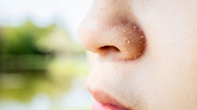 Primi freddi e naso screpolato: cosa fare