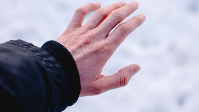 Geloni, i 5 rimedi naturali che forse non conoscevi