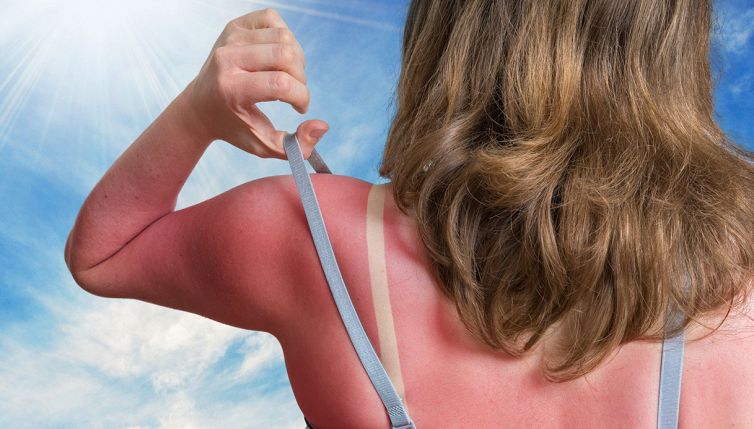 Scottatura solare, cosa evitare quando fai la doccia
