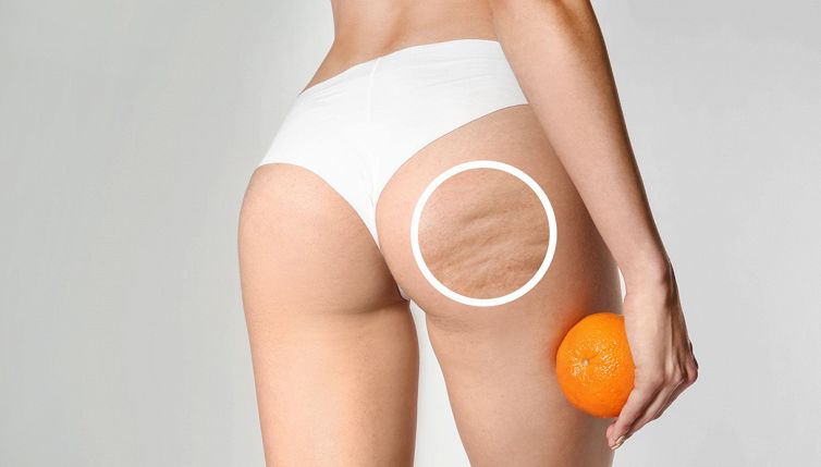 Cellulite, bastano 10 minuti al giorno: riducila in 2 settimane