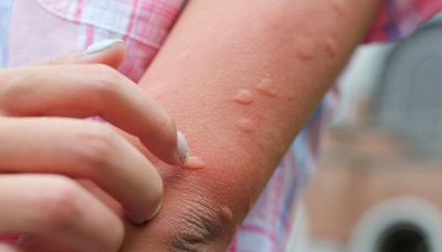 Tommaso Paradiso ha il Toscana virus: sintomi e come si trasmette