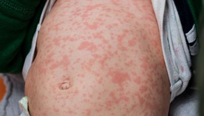 Allarme morbillo, Italia prima in Europa per numero di casi