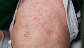 Allarme morbillo, Italia prima in Europa per numero di casi