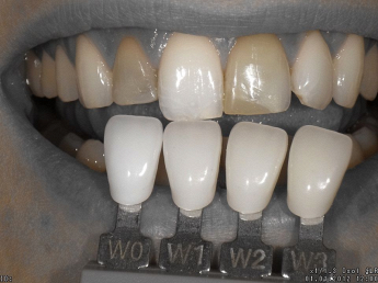Studio Dentistico Prosper Dr. Loris sbiancamento dentale