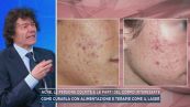Acne, le persone colpite e le parti del corpo interessate