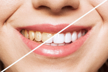 Il Sorriso Studio Dentistico IGIENE E PROFILASSI