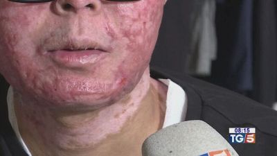 Crans-Montana, il racconto di uno dei sopravvissuti: "La mia vita rovinata in quei 30 secondi"