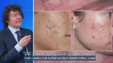 Acne, le persone colpite e le parti del corpo interessate