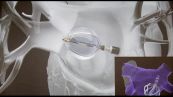Un "palloncino" per il trattamento della fibrillazione atriale
