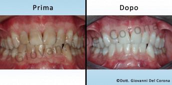 Studio Odontoiatrico Dottor Del Corona Giovanni Prima e dopo il trattamento