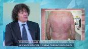 Psoriasi, le cause di insorgenza e le possibili cure