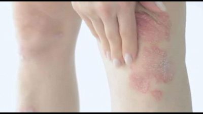Psoriasi Pustolosa Generalizzata, arriva un farmaco mirato